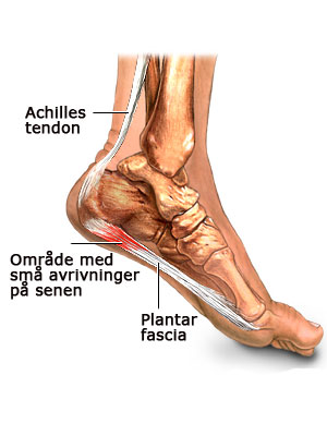 plantarfasciitt